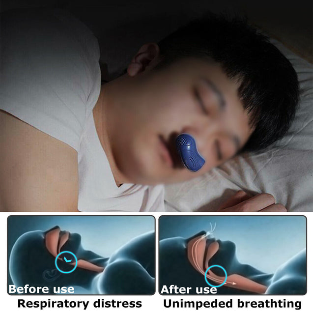 Micro Electric CAPA Noise Anti Snoring Device Sleep Apnea Stop Snore Aid Stopper