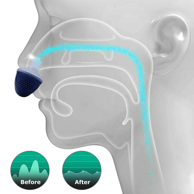 Micro Electric CAPA Noise Anti Snoring Device Sleep Apnea Stop Snore Aid Stopper
